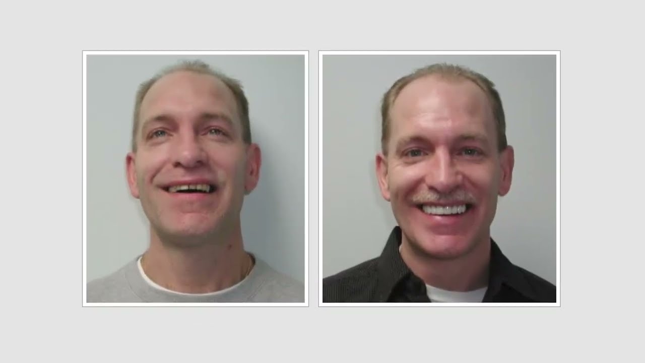 veneers